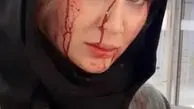 سولماز حصاری زخمی شد + عکس