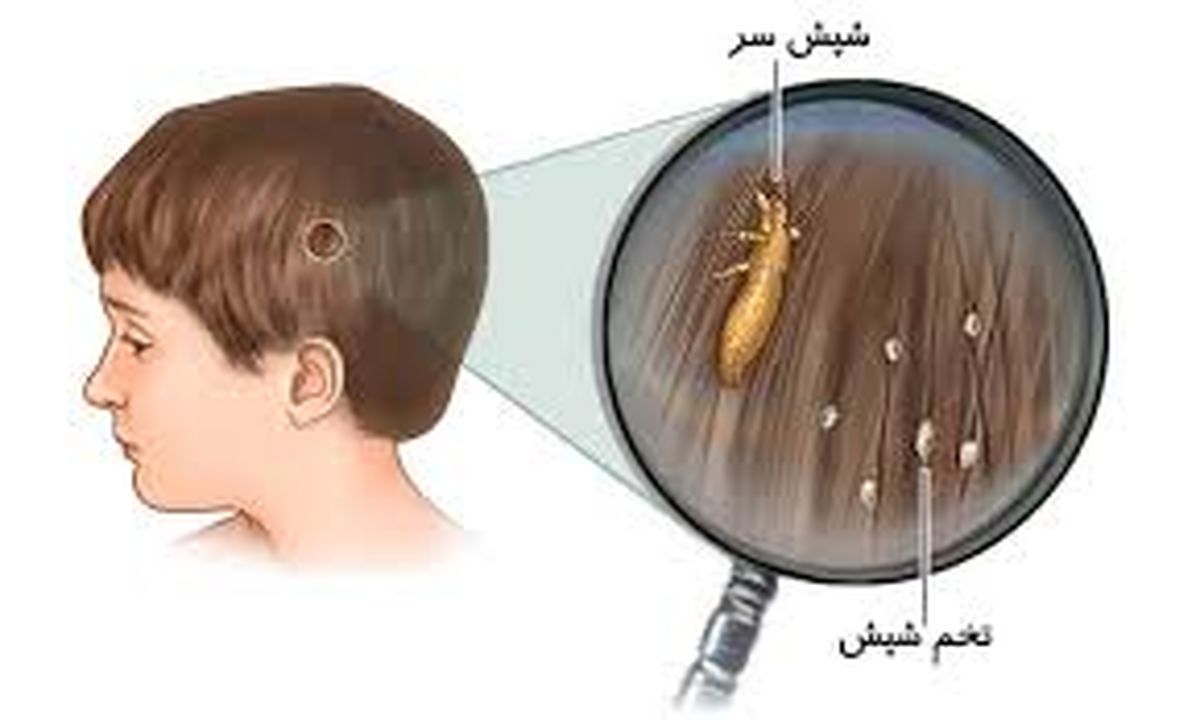 دلایل شیوع بیماری شپش در کودکان