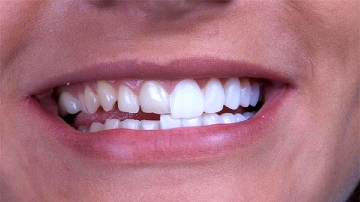 بررسی مهمترین عوارض کامپوزیت و لمینت 