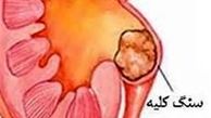 ایران روی کمربند سنگ کلیه قرار دارد