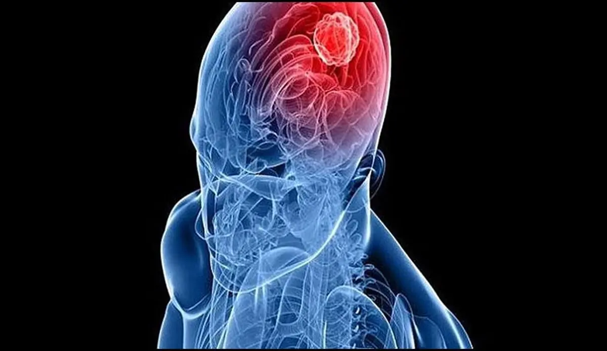 ویروس زیکا سلاح تومورهای مغزی شد