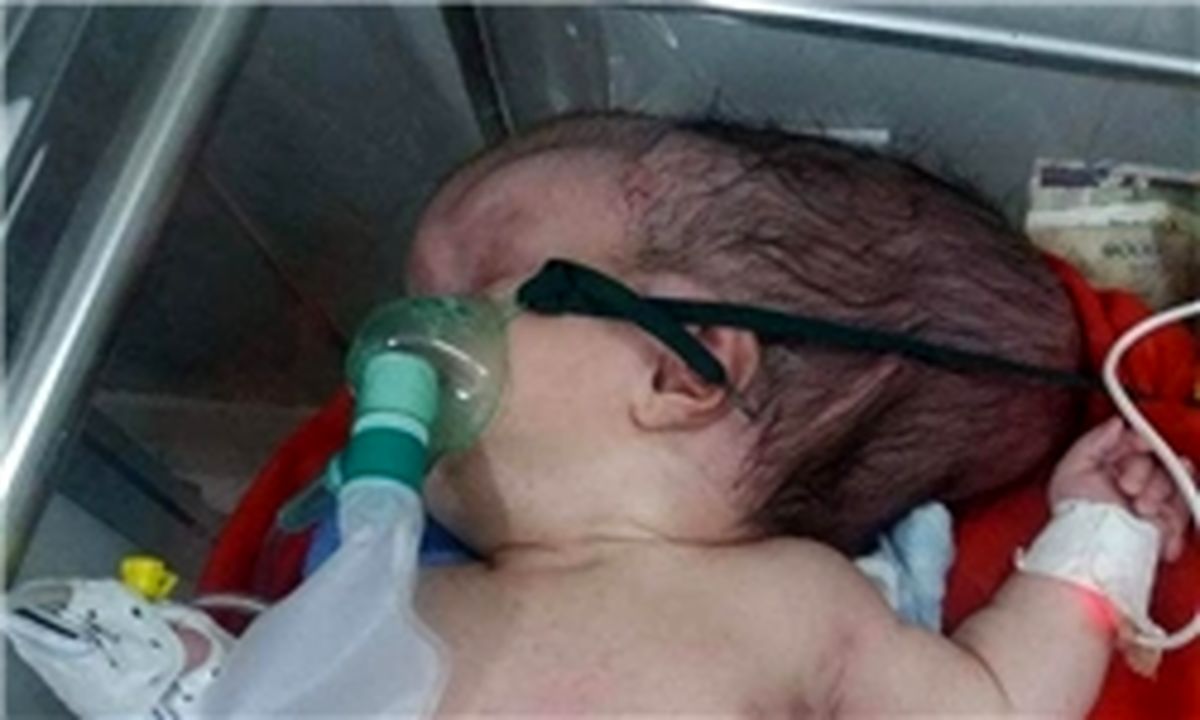 جمجمه این نوزاد نصفه است+تصاویر
