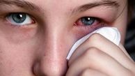 دمنوش های خانگی برای درمان قی کردن چشم