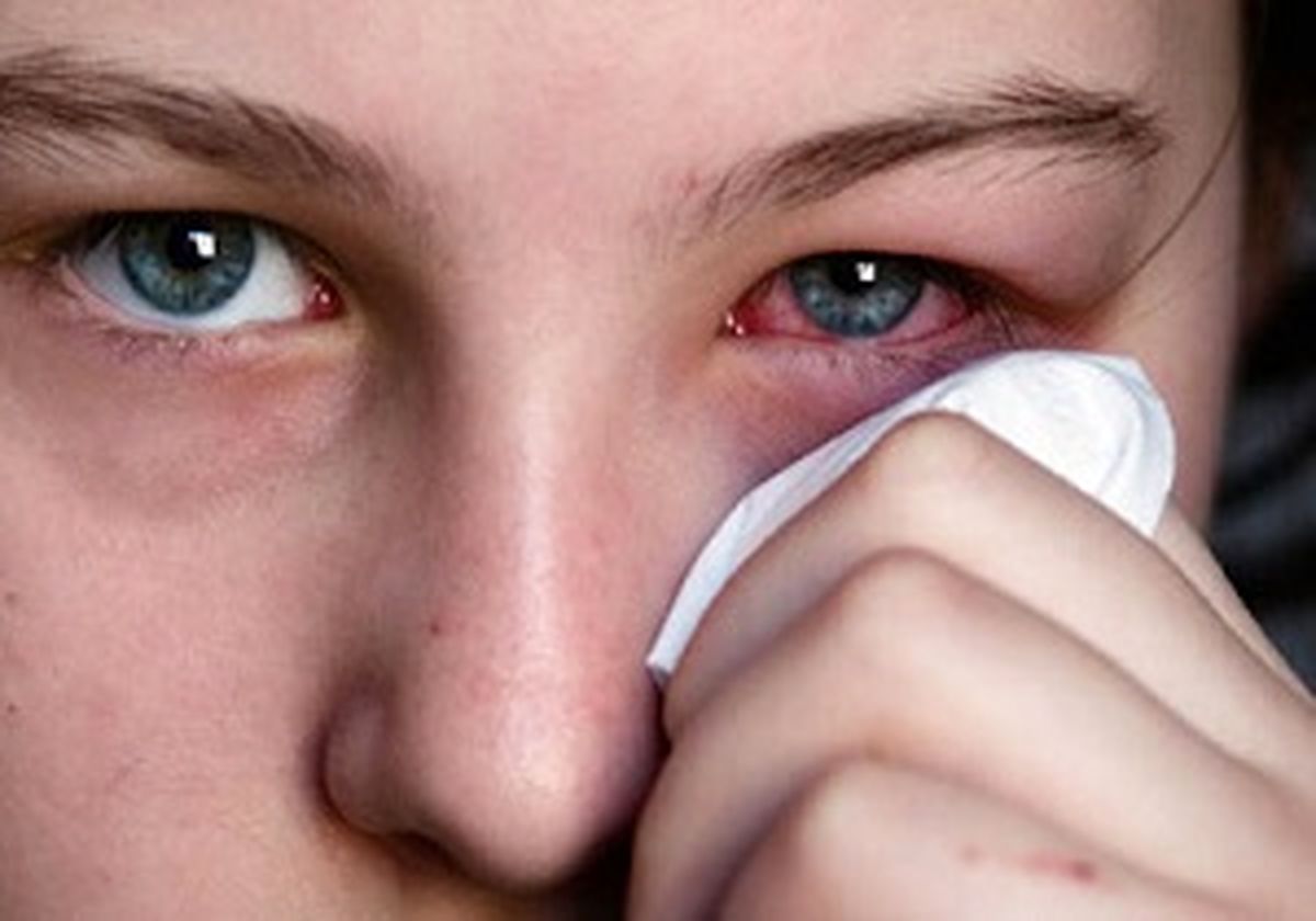 دمنوش های خانگی برای درمان قی کردن چشم