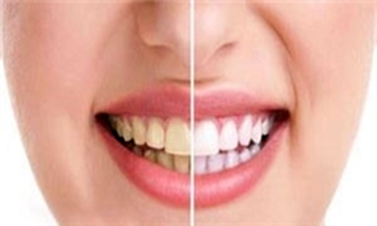 چگونه زردی دندان هایمان را رفع کنیم؟