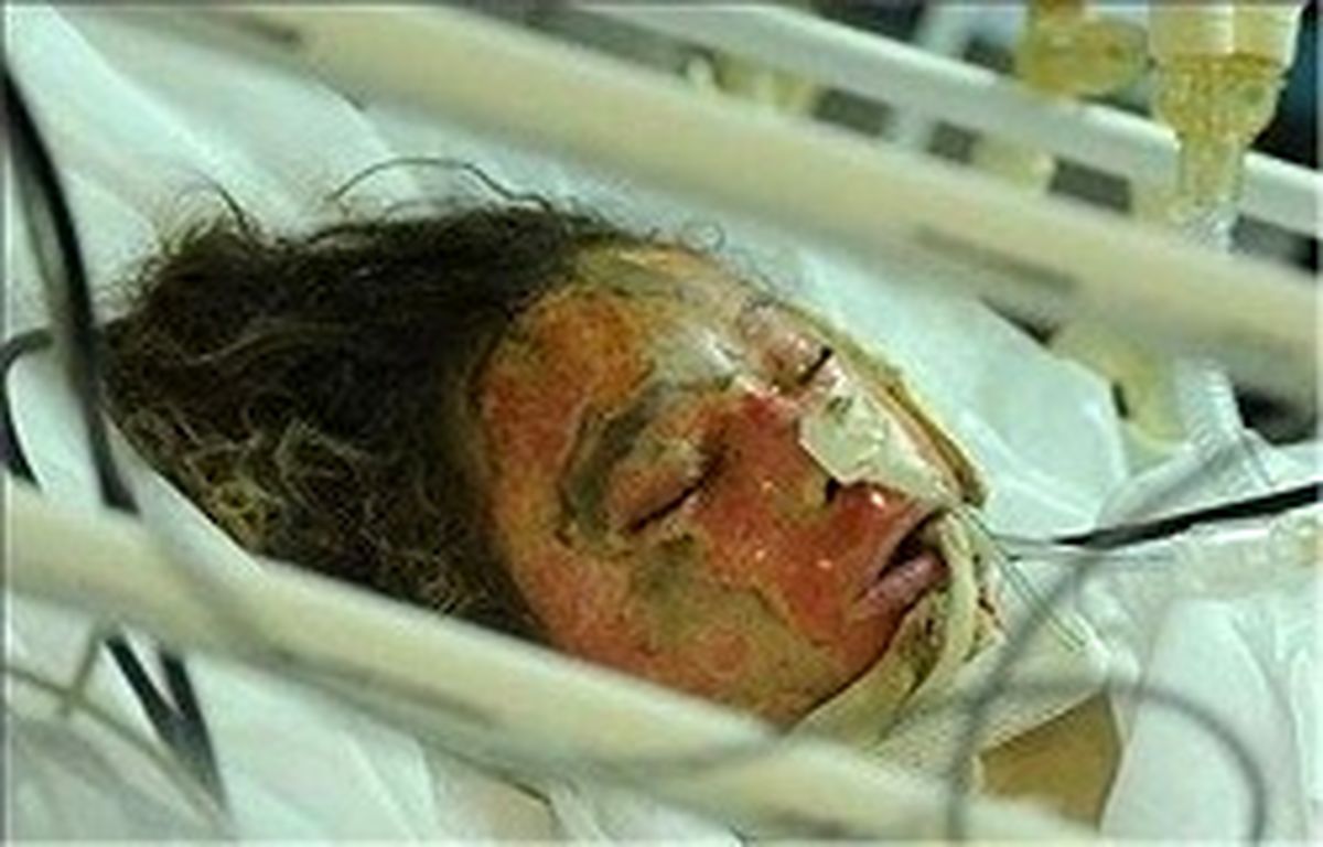 مرگ تلخ دو کودک بر اثر واژگونی دیگ آب‌جوش 