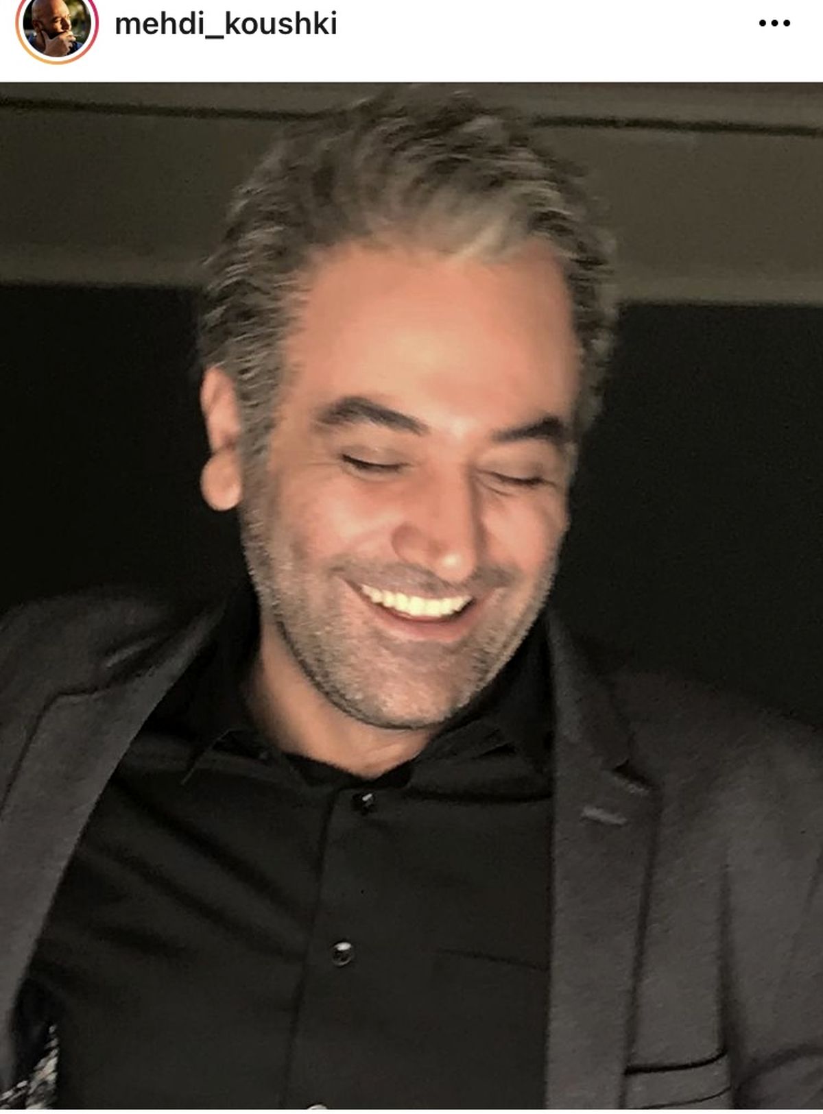 مهدی کوشکی هم مو کاشت + عکس