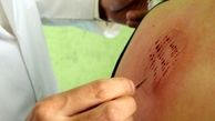 در این فصل حجامت کردن ممنوع است