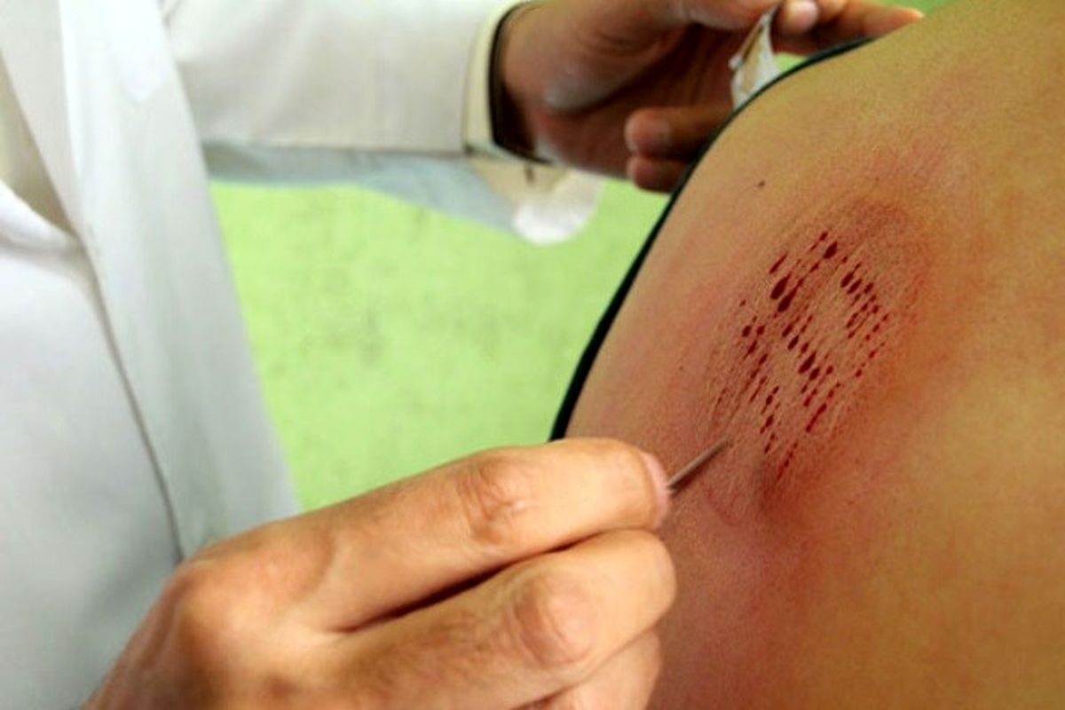 در این فصل حجامت کردن ممنوع است