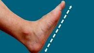 9 روش درمان صافی کف پا