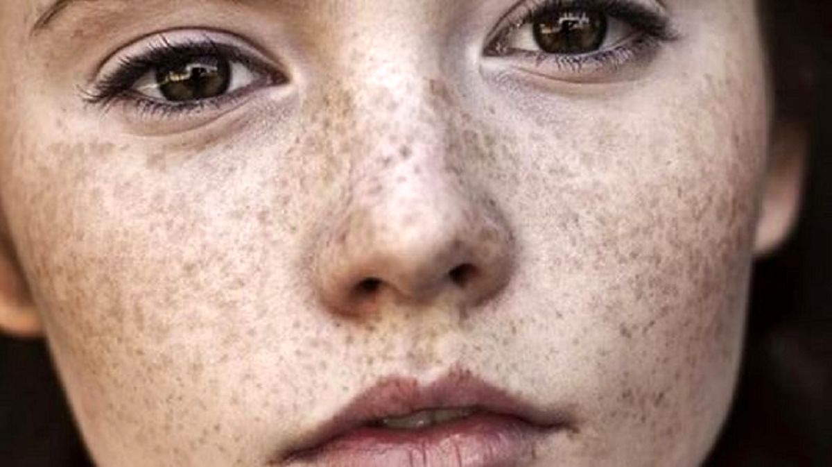 چرا روی پوست لکه می‌افتد؟