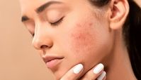 از بین بردن جای جوش با روش های خانگی ساده | این معجزه رو امتحان کن !