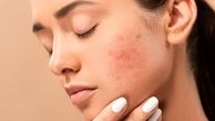 از بین بردن جای جوش با روش های خانگی ساده | این معجزه رو امتحان کن !