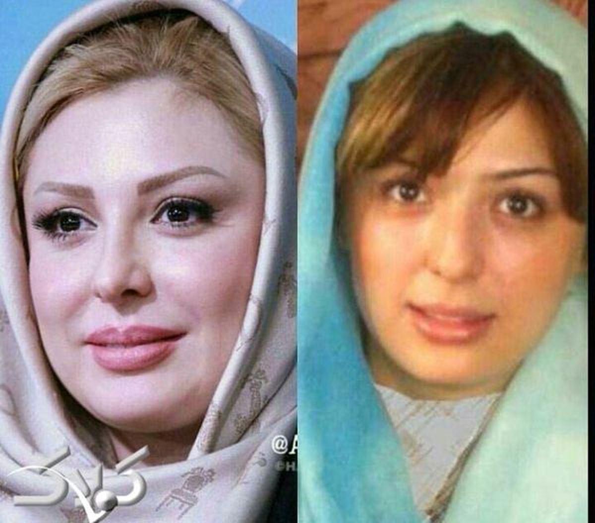 عکس قبل و بعد عمل نیوشا ضیغمی