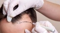 چه روشی را برای کاشت مو انتخاب کنم؟