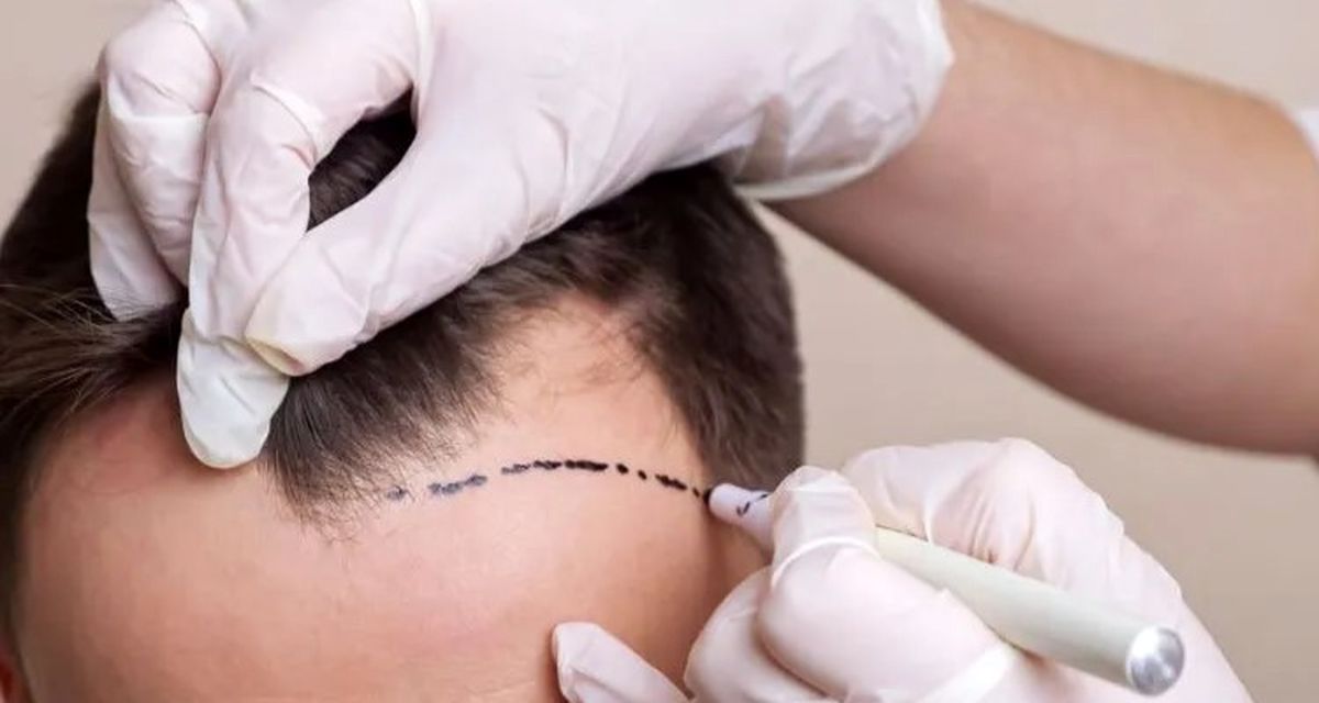 چه روشی را برای کاشت مو انتخاب کنم؟