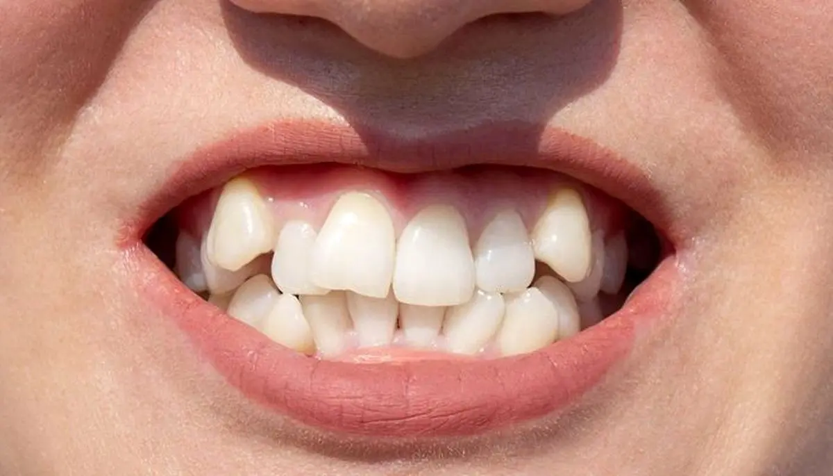 روش خانگی برای صاف شدن دندان