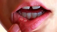 دلیل آفت دهان کمبود کدام ویتامین هاست؟