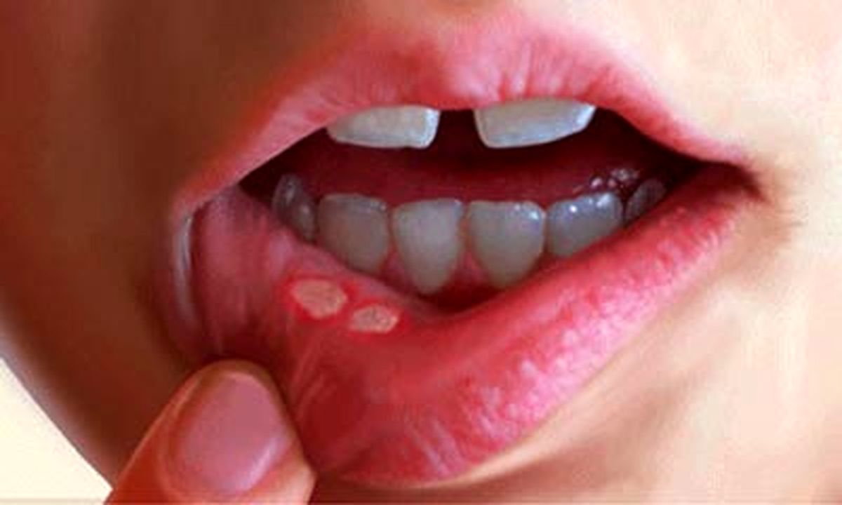 دلیل آفت دهان کمبود کدام ویتامین هاست؟