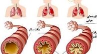 پرهیزات غذایی در مبتلایان به آسم از منظر طب سنتی 