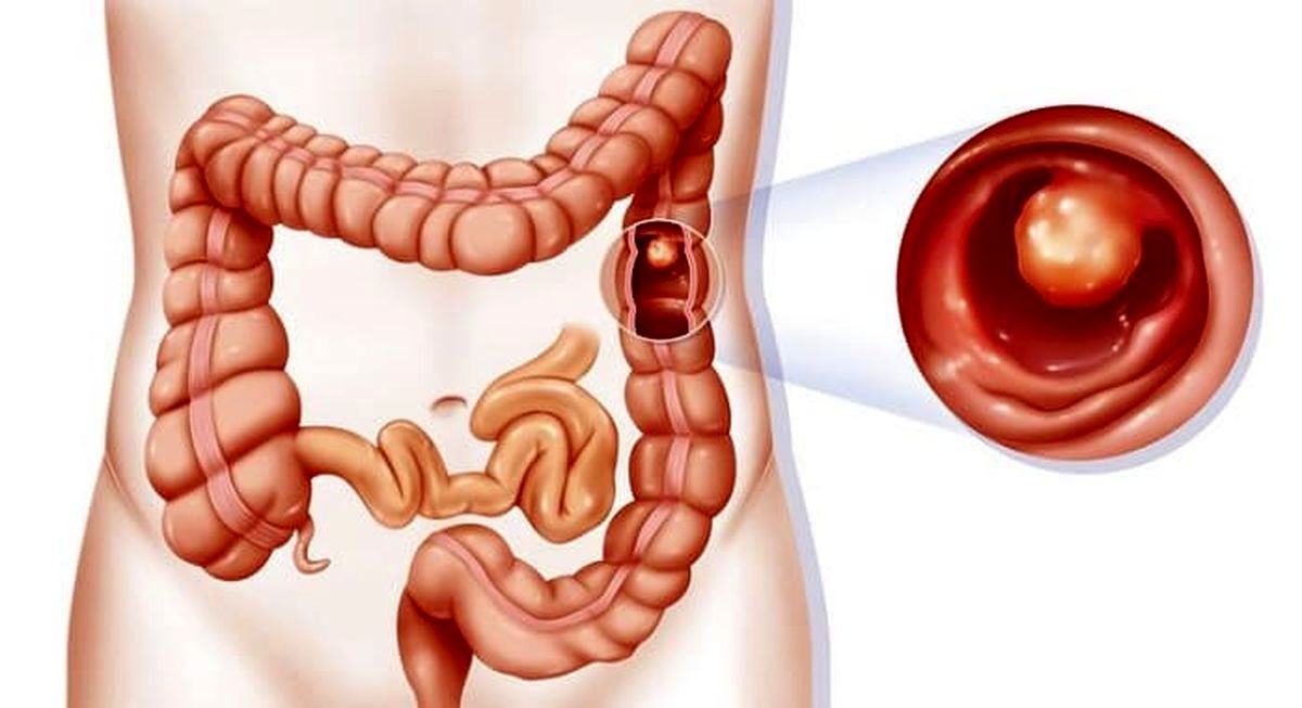 مشکل پوستی که می‌گوید وضعیت روده‌هایتان خراب است