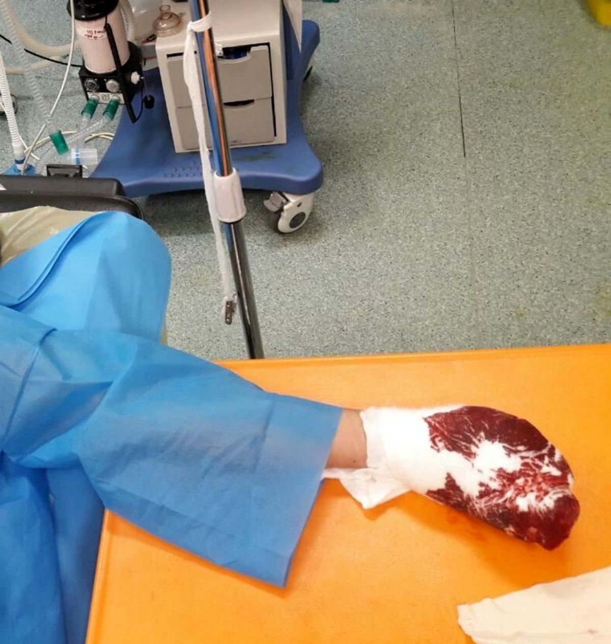 انفجار مواد محترقه انگشتان جوان مرندی را قطع کرد