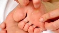  چرا کف پا پوسته پوسته می‌شود ؟