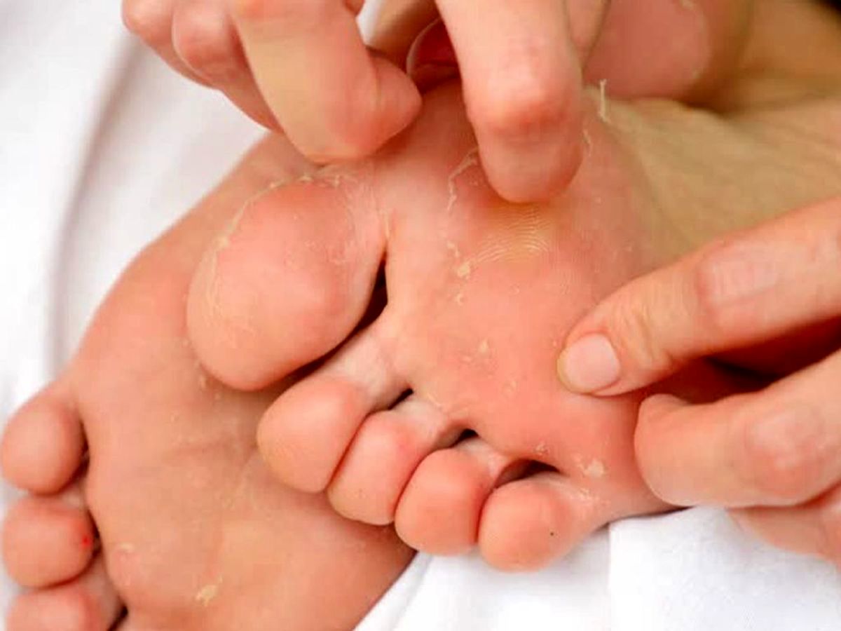  چرا کف پا پوسته پوسته می‌شود ؟