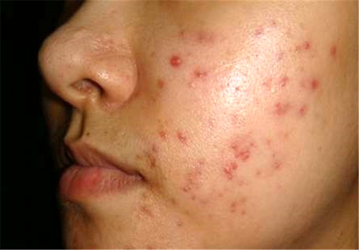 باورهای غلط درباره آکنه را فراموش کنید