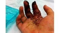 بیماری که به دلیل قطع انگشتان دست پذیرش نشد!