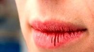 علت ترک خوردن لب‌ها چیست ؟