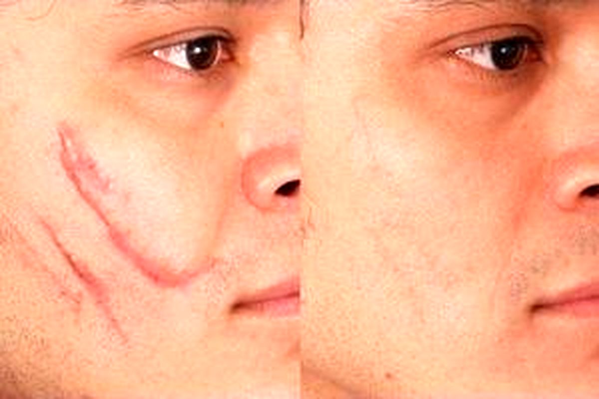 چگونه جای زخمهای قدیمی را از بین ببریم؟ 