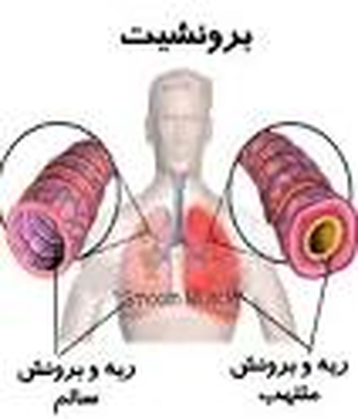 علائم برونشیت را بشناسیم