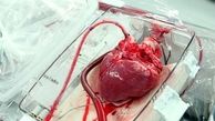 يک ماده واحده براي 80 سال سابقه پيوند اعضا در ايران!
