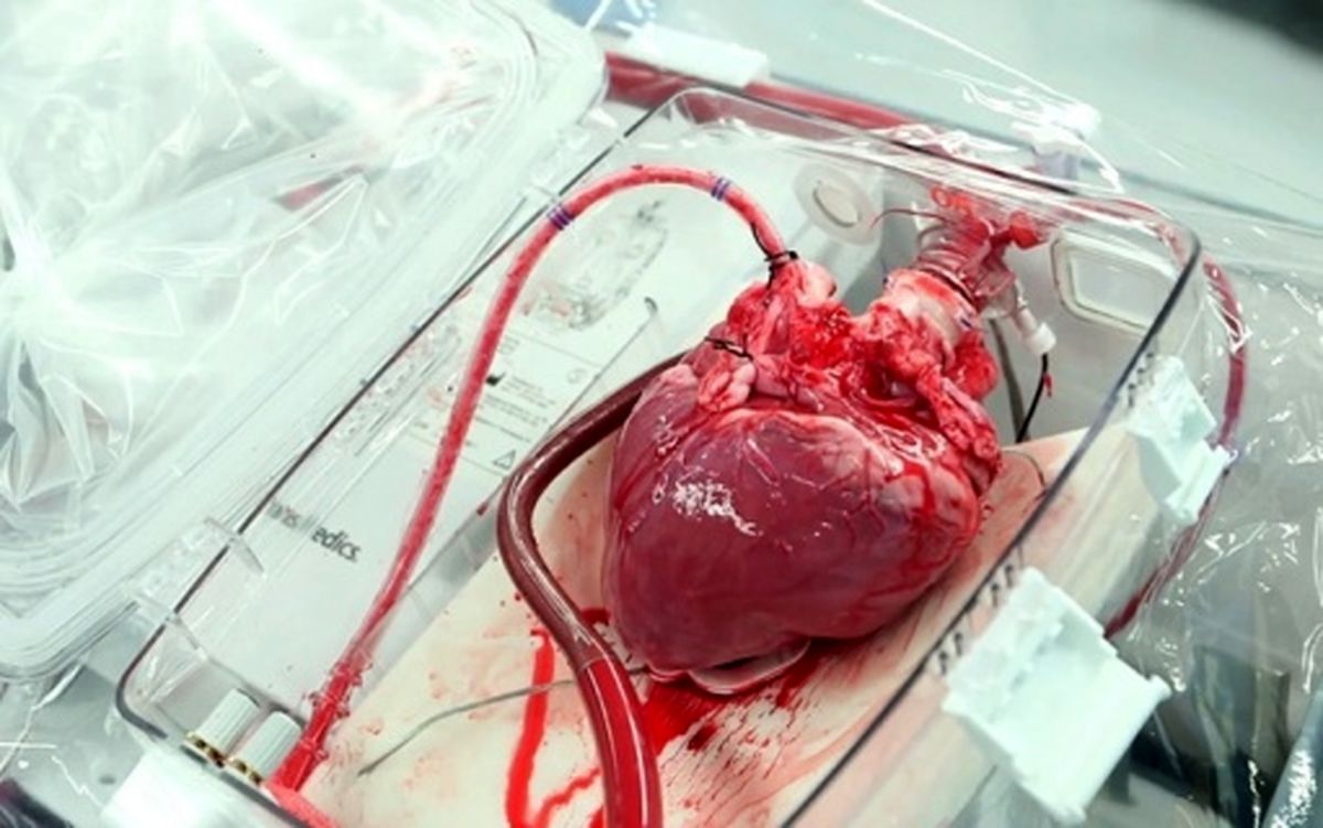 يک ماده واحده براي 80 سال سابقه پيوند اعضا در ايران!