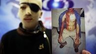 دیدگاه قربانیان اسیدپاشی در رابطه با اجرای اولین حکم قصاص/ سال ٩٣ اسیدی‌ترین سال در کشور بود