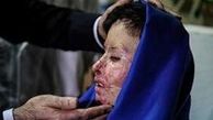 
قربانی اسیدپاشی به آمریکا رفت
