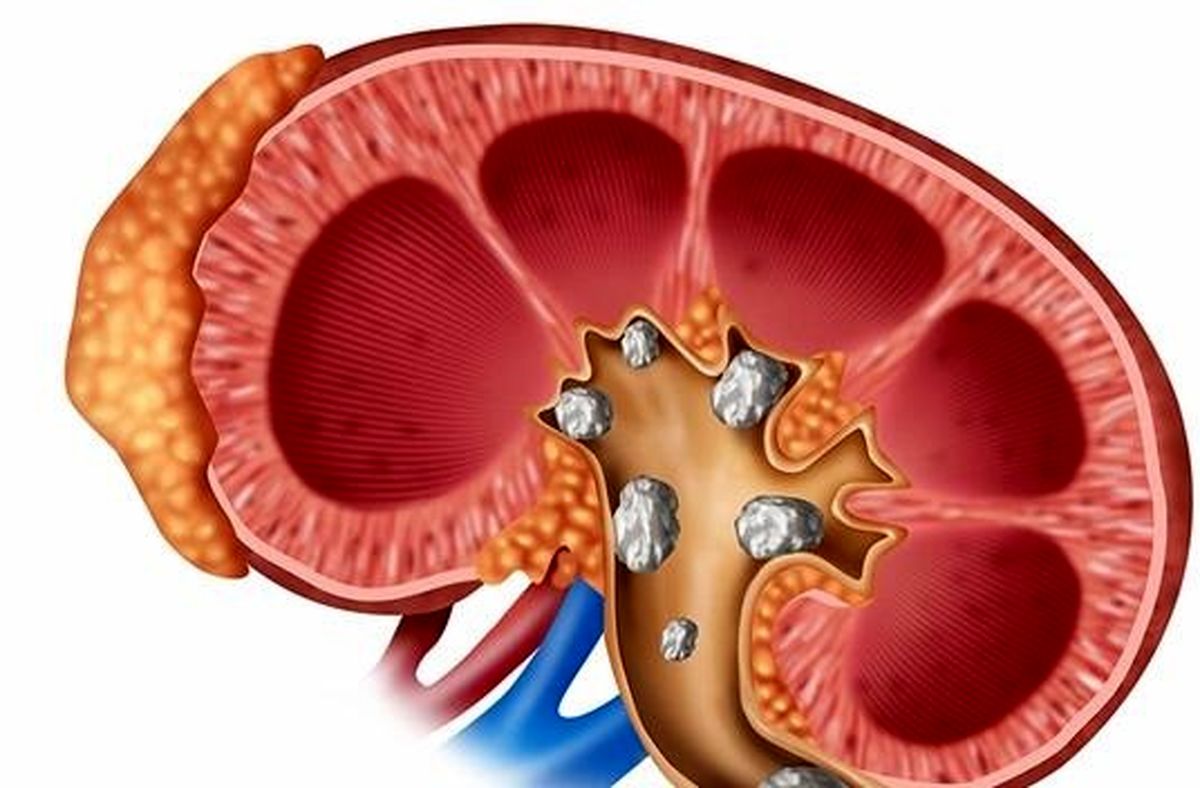 راه‌های جلوگیری از ابتلا به سنگ کلیه 