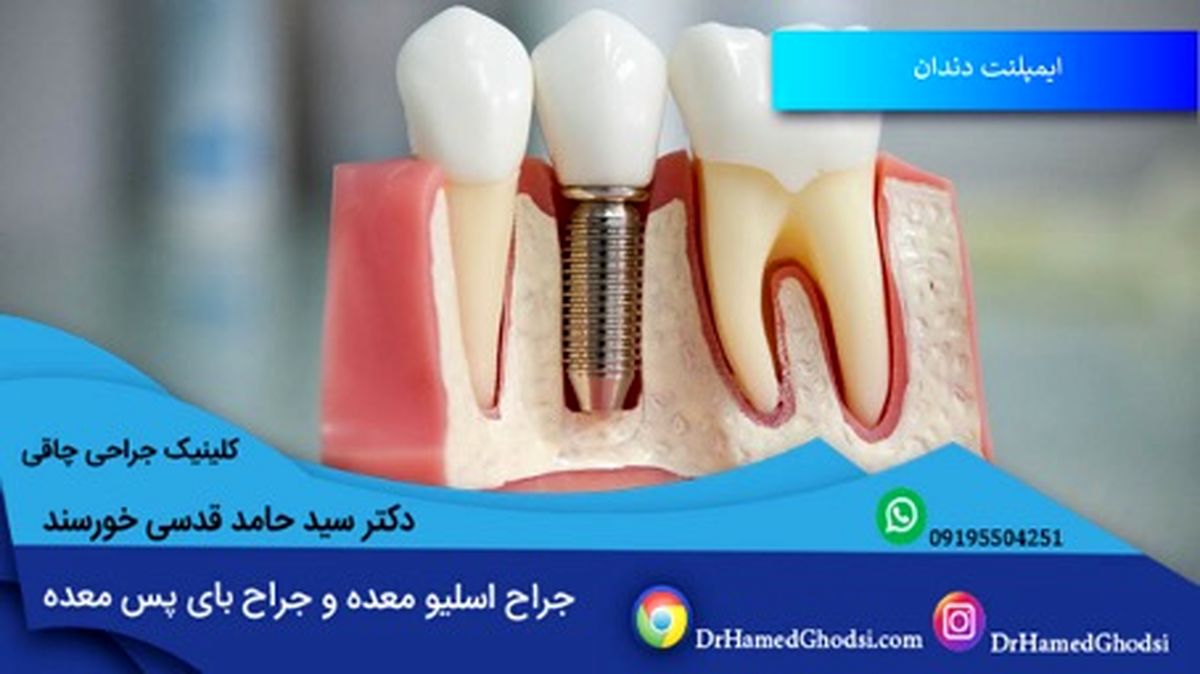 ایمپلنت دندان