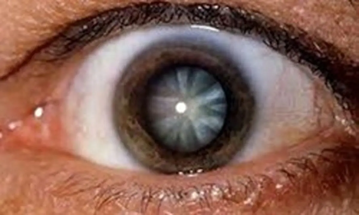 تغییرات مکرر نمره چشم نشانه چه بیماری است؟