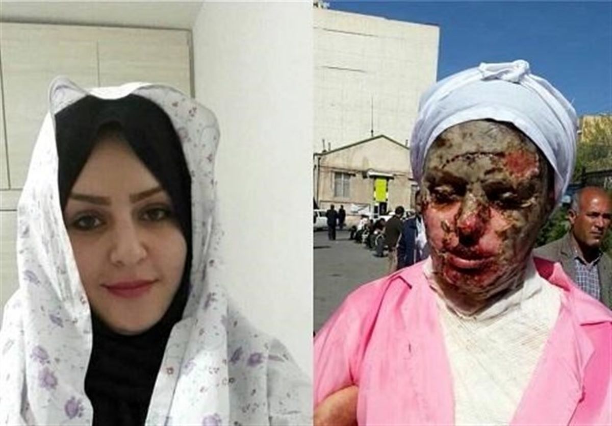 بررسی طرح تشدید مجازات اسیدپاشی