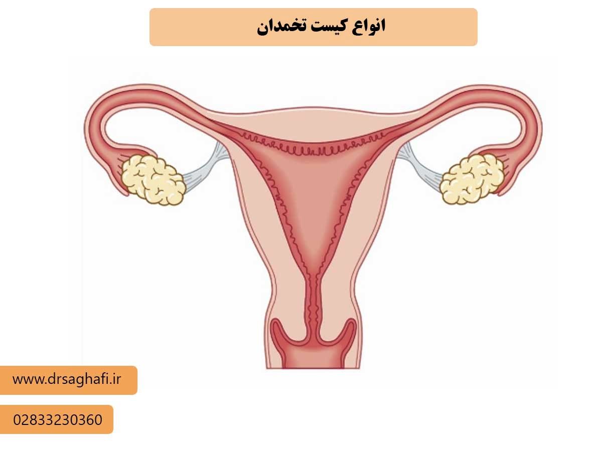 توضیحات دکتر هدیه ثقفی متخصص زنان در قزوین درباره انواع کیست تخمدان