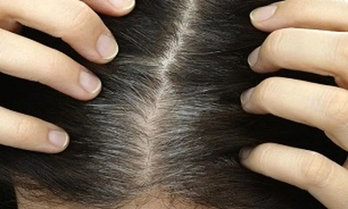 ماسک ماست و تخم مرغ روشی مناسب برای سلامت موی سر