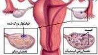 این ۲ عامل رایج تولید کیست در خانم ها که توجه نمی‌کنند