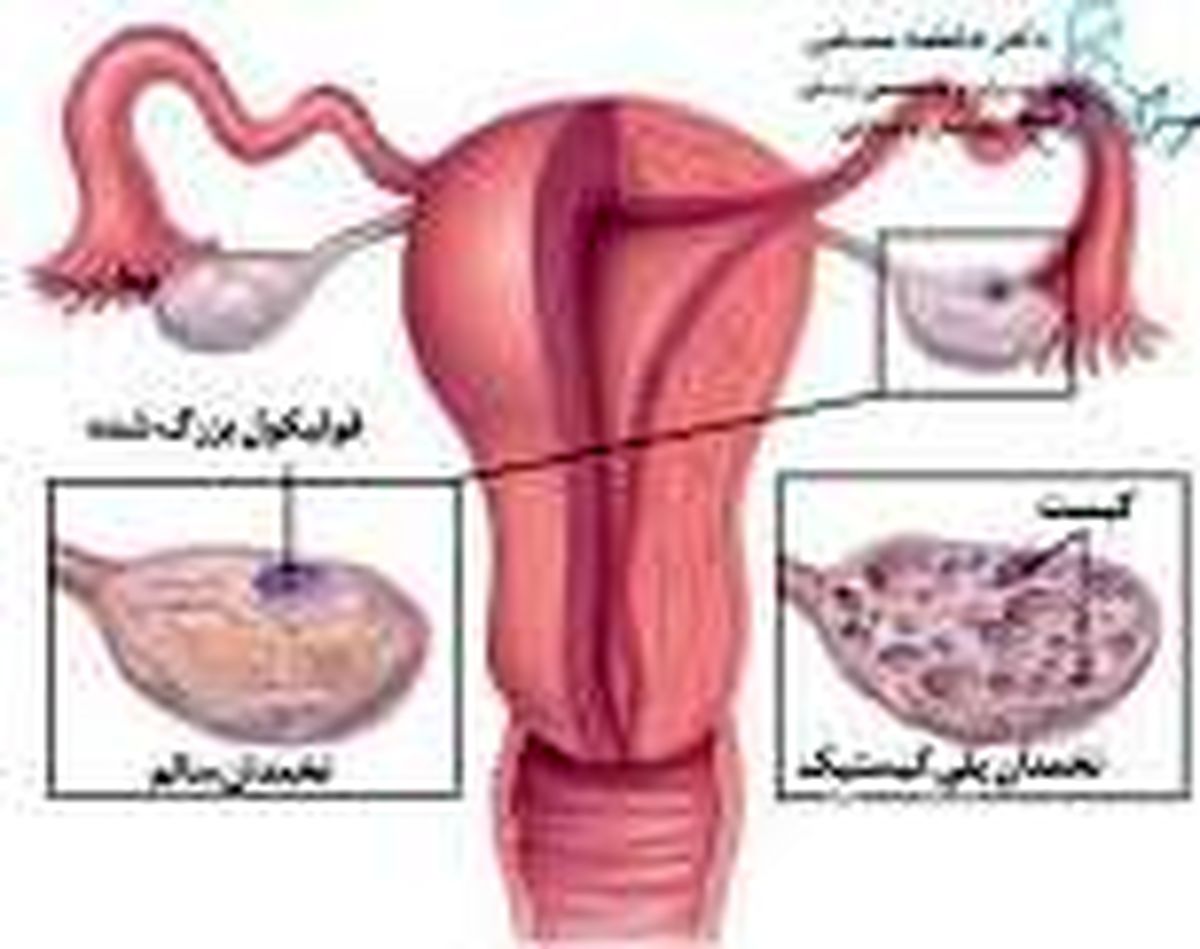 این ۲ عامل رایج تولید کیست در خانم ها که توجه نمی‌کنند