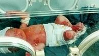 آخرین وضعیت پرونده سوختگی نوزاد سه روزه 