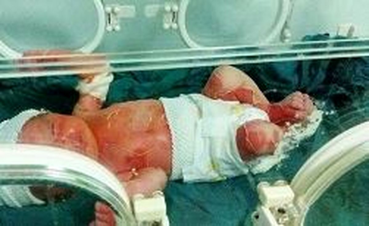 آخرین وضعیت پرونده سوختگی نوزاد سه روزه 