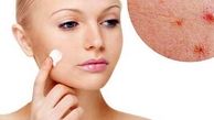 چرا وقتی مراسم‌ مهمی داریم جوش می‌زنیم