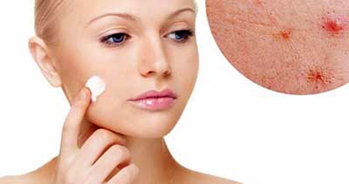 چرا وقتی مراسم‌ مهمی داریم جوش می‌زنیم
