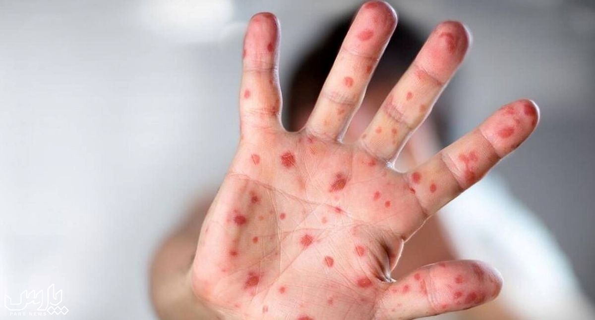 راه های انتقال آبله میمون و نحوه در امان ماندن از آن